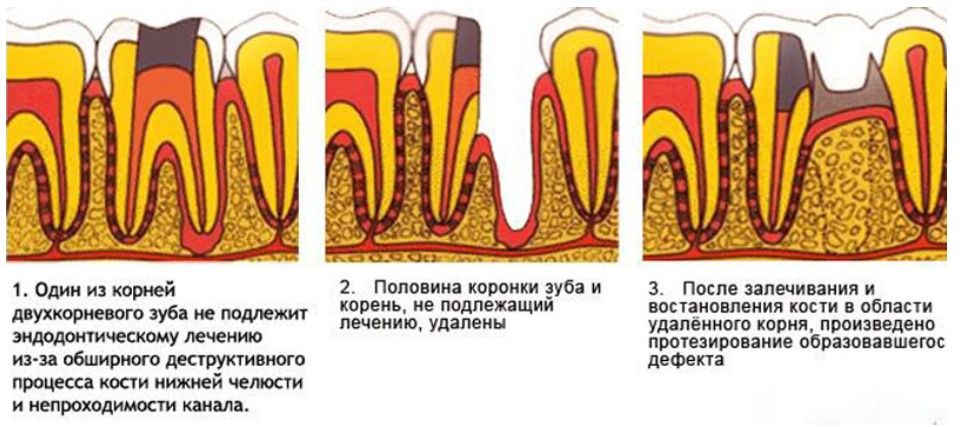 Иллюстрация гемисекции зуба