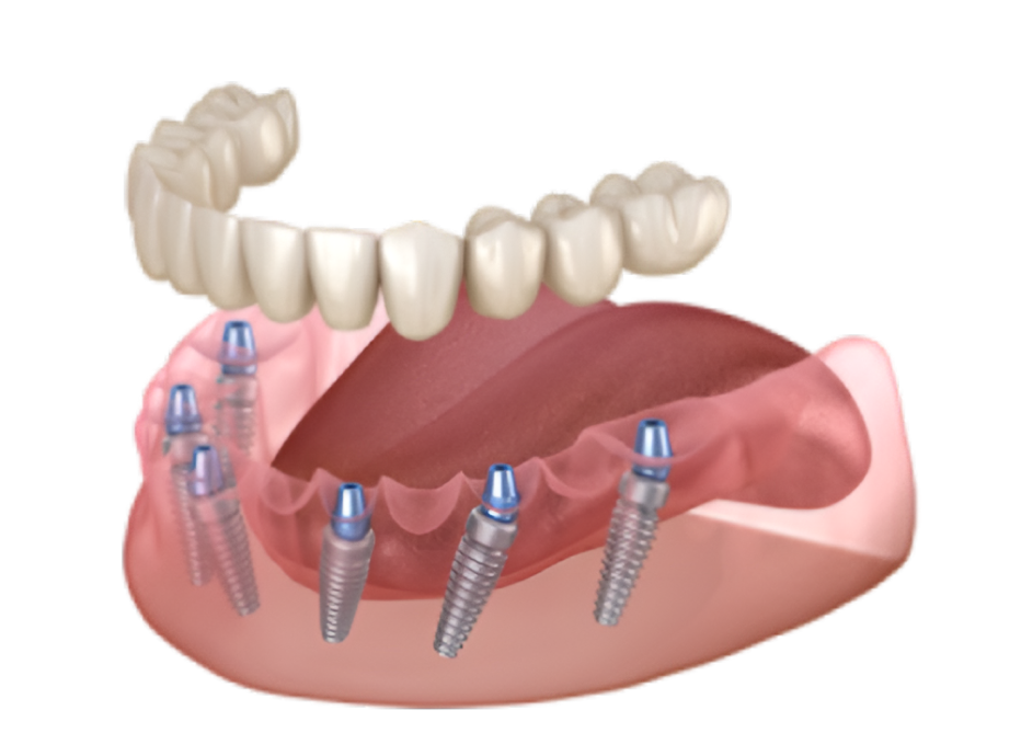 All-on-6 имплантаты
