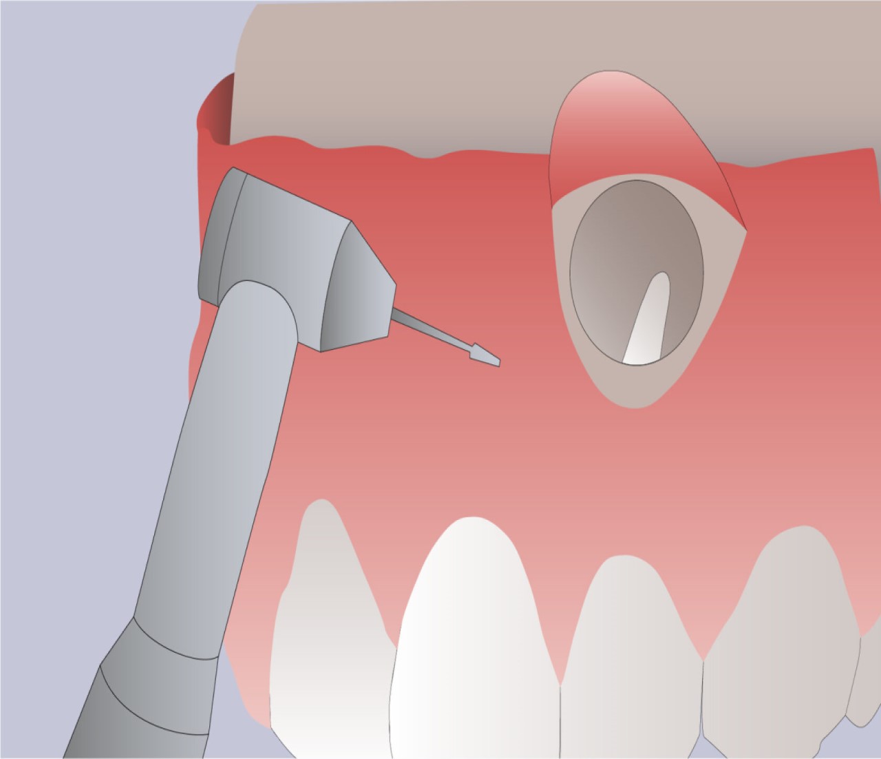 Резекция верхушки корня