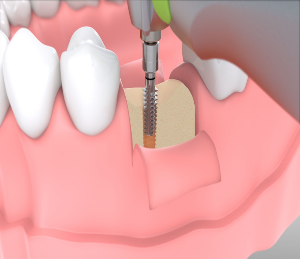 имплант зуба