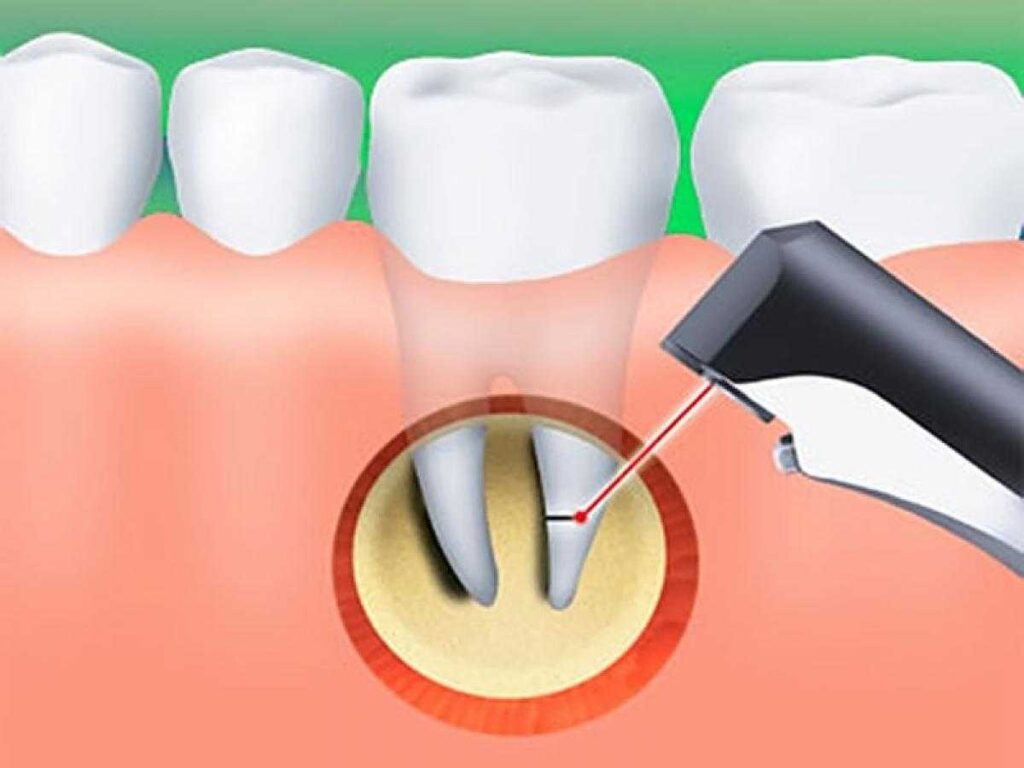 Воспаление верхушки корня зуба