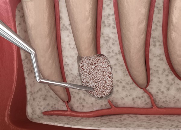Ампутация корня зуба